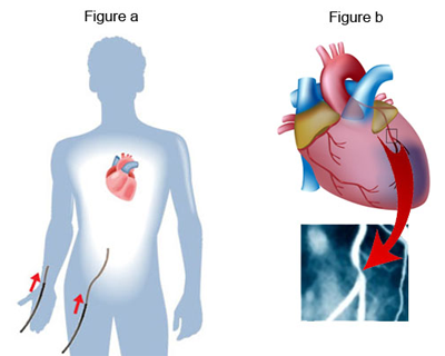 angiogram-Fig-a-and-b