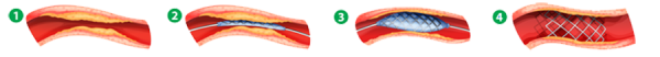 angioplasty-diagram