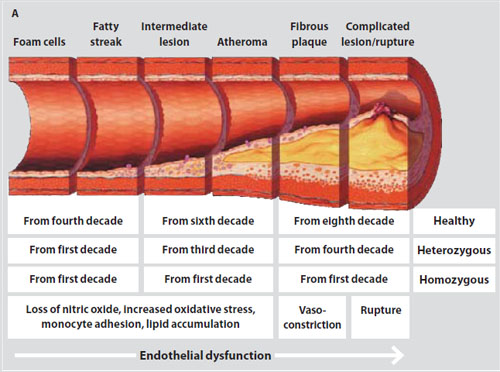 atherosclerosis-development