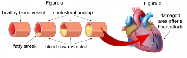 atherosclerosis